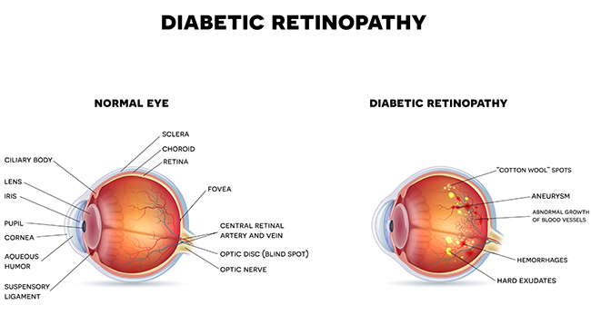 Diabetic Retinopathy kansas city