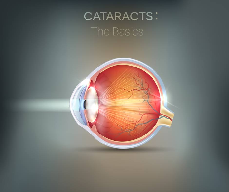 can-cataract-lens-be-replaced