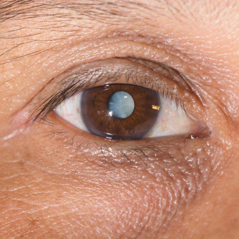 laser cataract surgery saint joseph mo