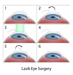 LASIK Kansas City, MO – Laser Eye Surgery St. Joseph, MO