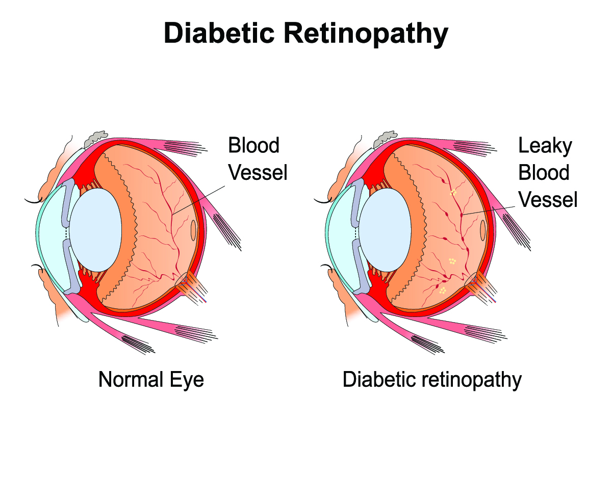 Diabetic Retinopathy Treatment Kansas City, MO